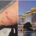 Detectan brote de chinches en cuatro de los hoteles más conocidos en Las Vegas