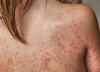 La psoriasis, una enfermedad en la piel que afecta a mujeres y hombres; aunque sea tratada no se elimina, advierte especialista del CIDOCS