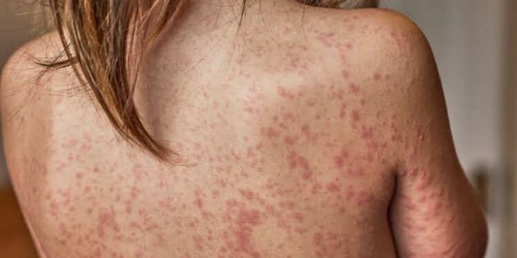 La psoriasis, una enfermedad en la piel que afecta a mujeres y hombres; aunque sea tratada no se elimina, advierte especialista del CIDOCS