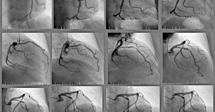 Doctorando de la UAS desarrolla método experimental a partir de imágenes de angiogramas para prevenir enfermedades cardiacas graves