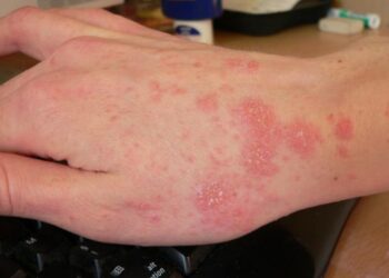 El compartir ropa usada sin desinfectar puede originar la escabiosis en el ser humano, la cual es de alta prevalencia en Sinaloa