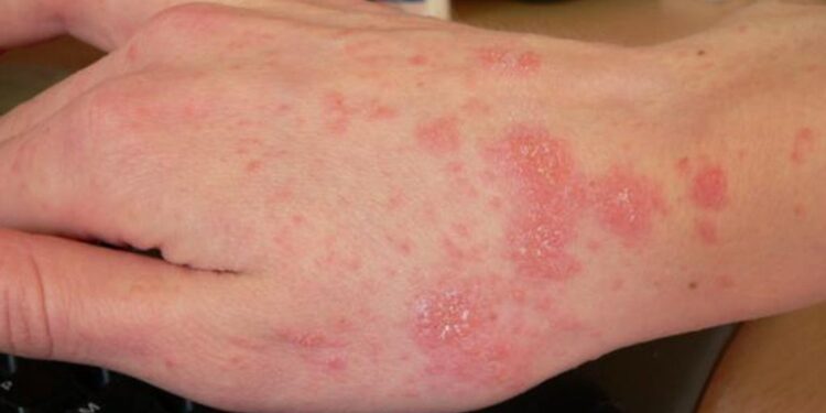 El compartir ropa usada sin desinfectar puede originar la escabiosis en el ser humano, la cual es de alta prevalencia en Sinaloa