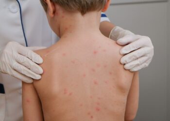 Ante el brote de sarampión que hay en el país, especialista de la UAS pide a la población sinaloense acudir de inmediato al médico si presenta síntomas