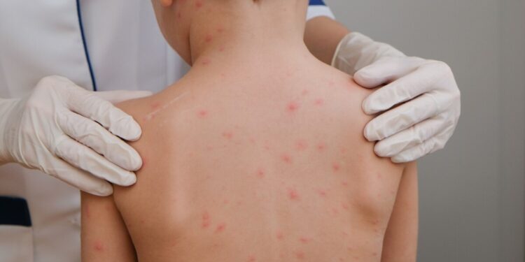 Ante el brote de sarampión que hay en el país, especialista de la UAS pide a la población sinaloense acudir de inmediato al médico si presenta síntomas