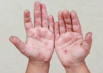 Sepyc atiende 52 reportes de Coxsackie en Sinaloa