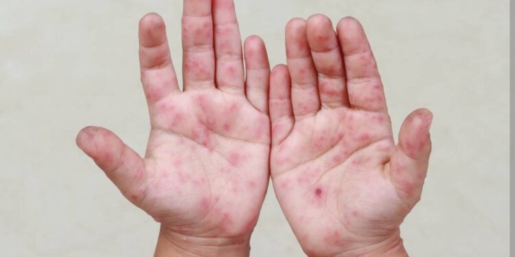 Sepyc atiende 52 reportes de Coxsackie en Sinaloa