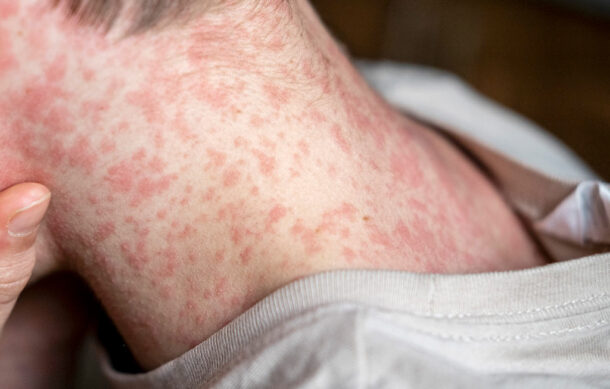 Aumentan contagios de sarampión en Sinaloa; Salud refuerza cerco sanitario