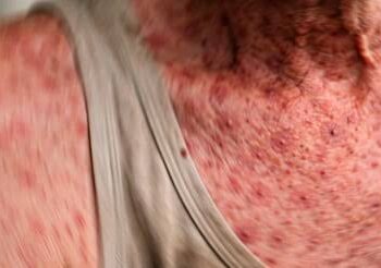 Primera muerte por sarampión en Sinaloa durante brote actual; víctima no estaba vacunada